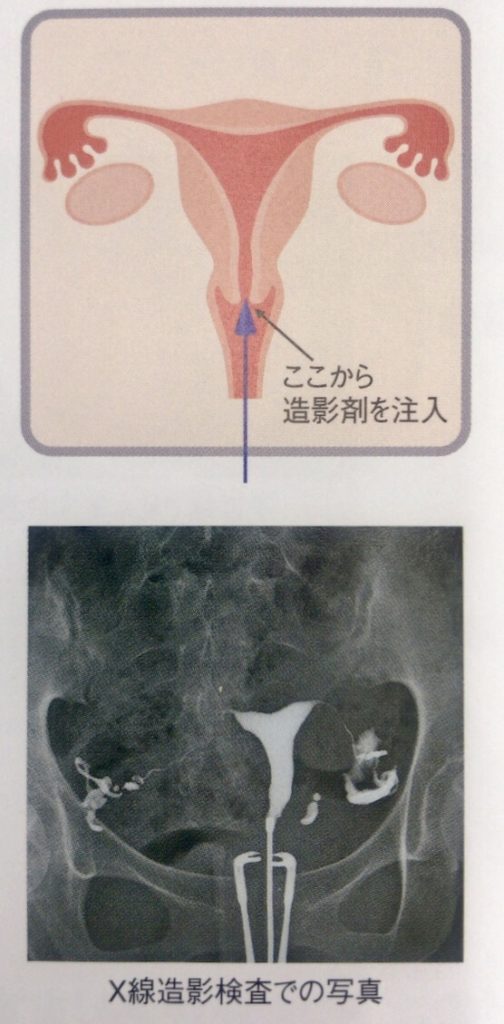 X線子宮卵管造影検査