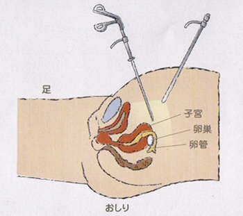 腹腔鏡検査・手術